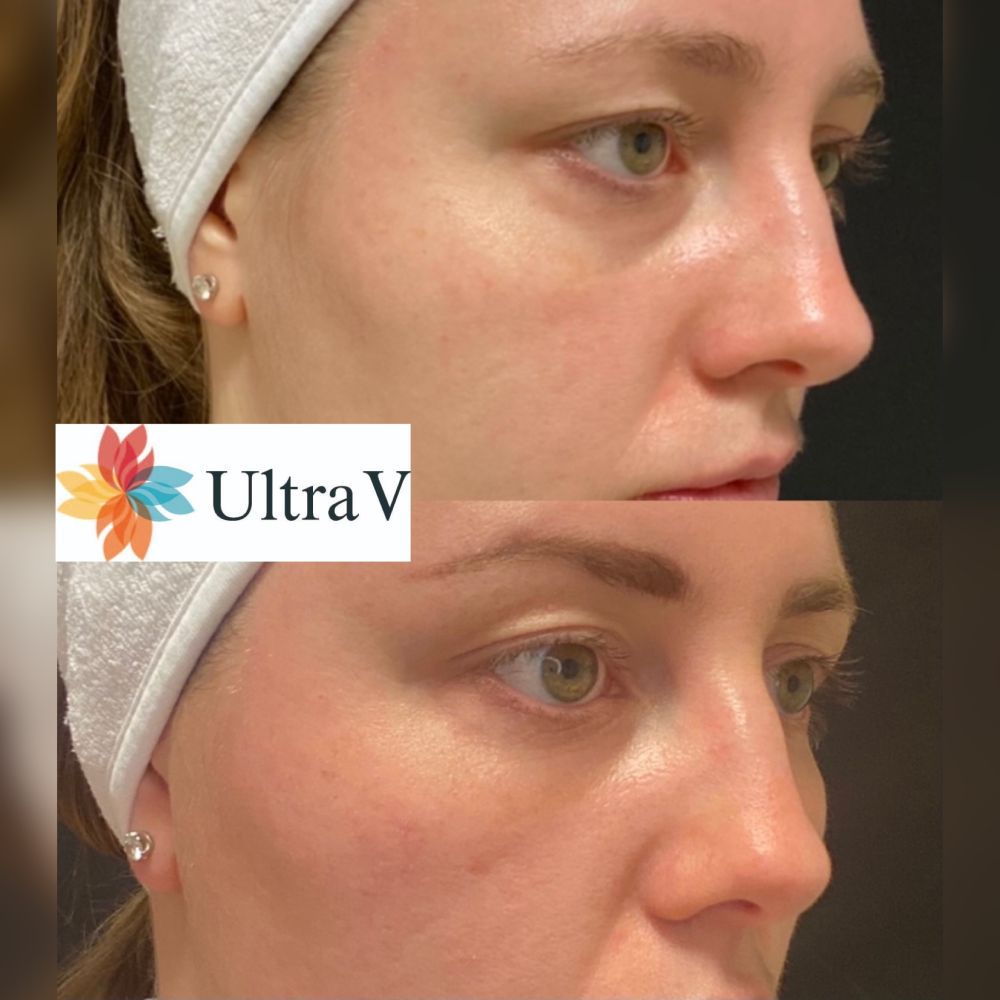 Behandling under ögonen med Ultra V PDO. Håligheten under ögonen har minskat och även färgen har ljusnat.
