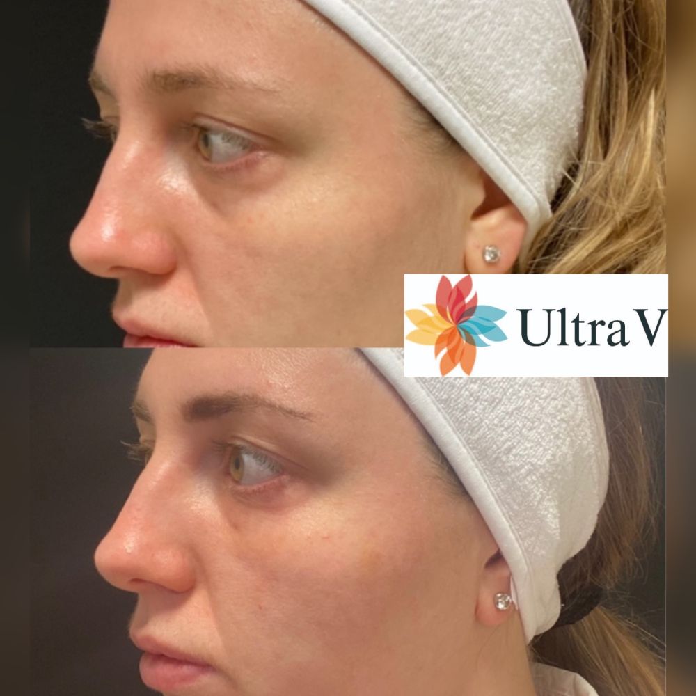Ihåligheten under ögonen har minskat efter behandling med Ultra V PDO.